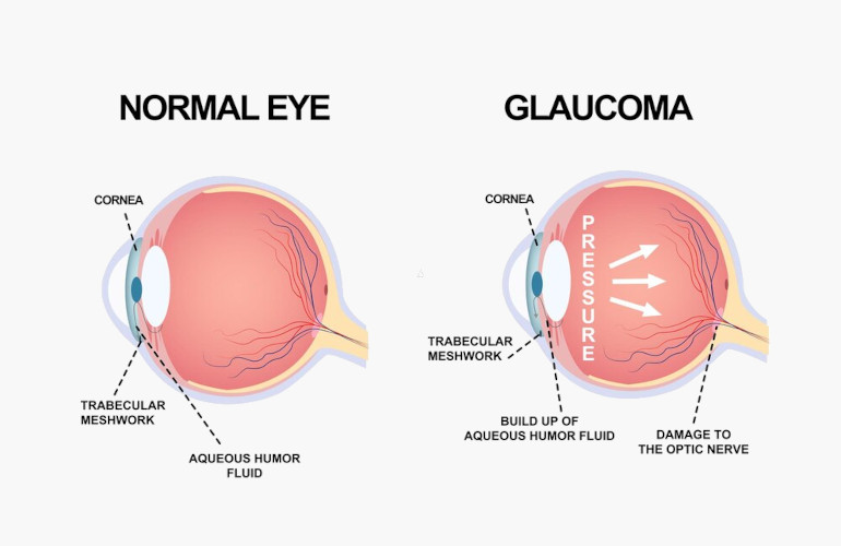 Dr Chhabildas Sanghvi Eye Hospital & Medical Center